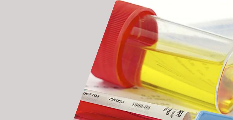 Niveles elevados de creatinina en sangre